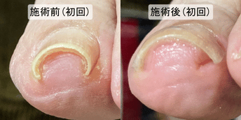 巻き爪 中度