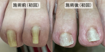 巻き爪 重度