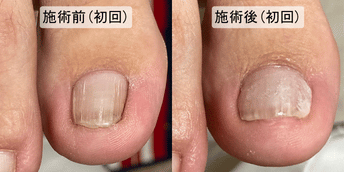 陥入爪